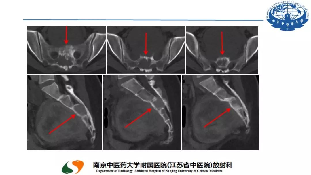 【PPT】孤立性纤维瘤的影像学表现
