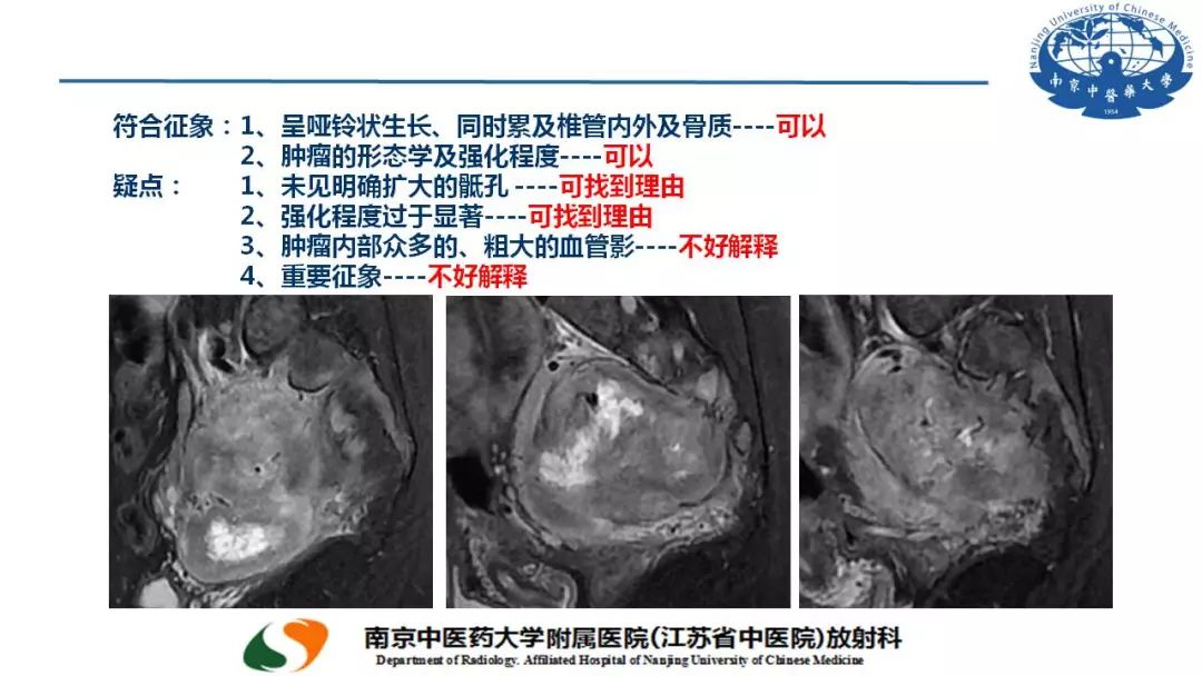 【PPT】孤立性纤维瘤的影像学表现
