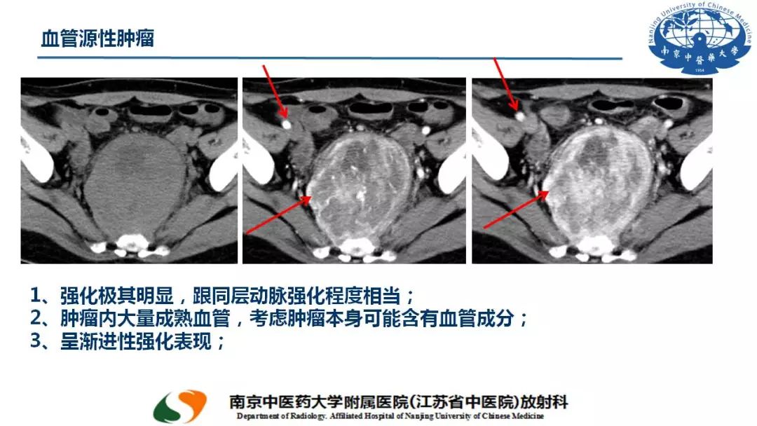 【PPT】孤立性纤维瘤的影像学表现