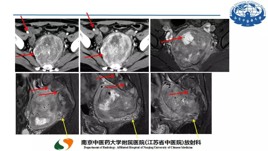 【PPT】孤立性纤维瘤的影像学表现