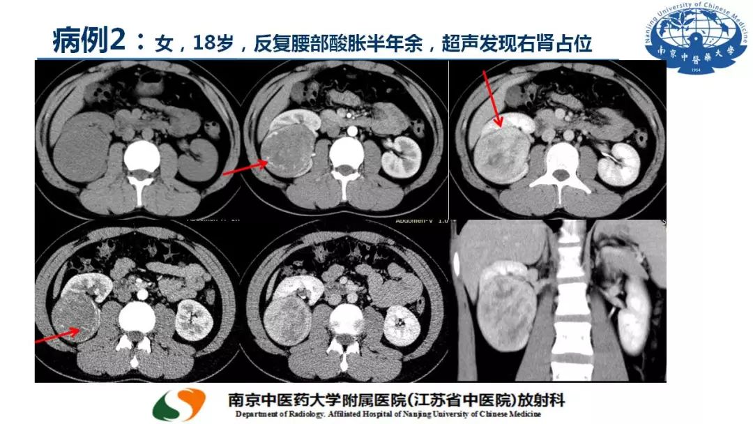 【PPT】孤立性纤维瘤的影像学表现