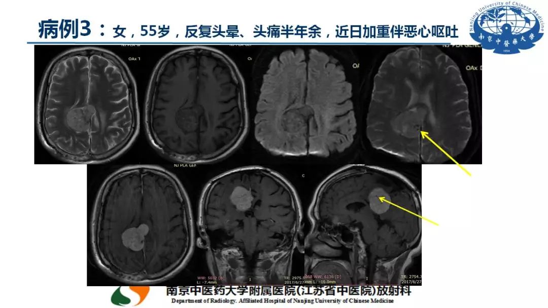 【PPT】孤立性纤维瘤的影像学表现