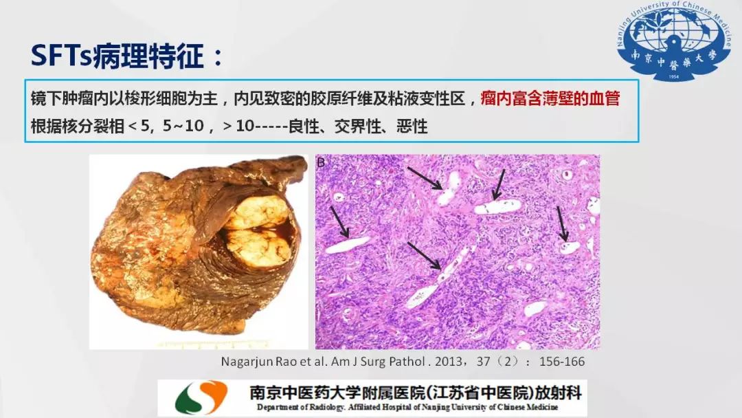 【PPT】孤立性纤维瘤的影像学表现