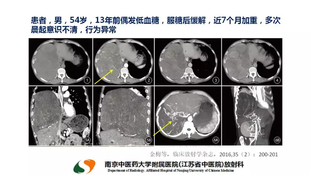 【PPT】孤立性纤维瘤的影像学表现