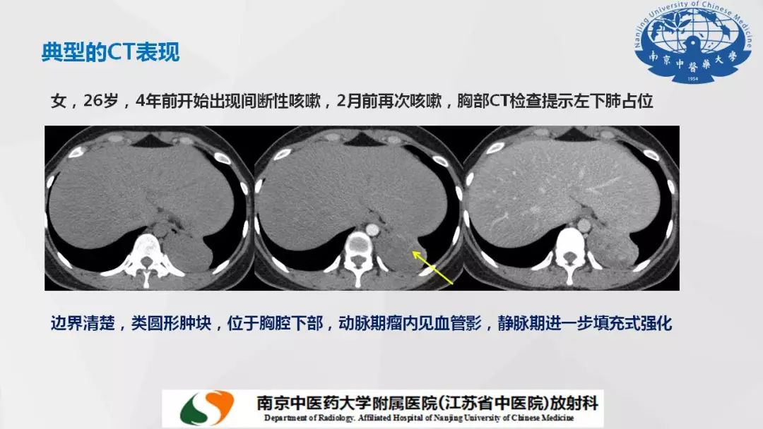 【PPT】孤立性纤维瘤的影像学表现