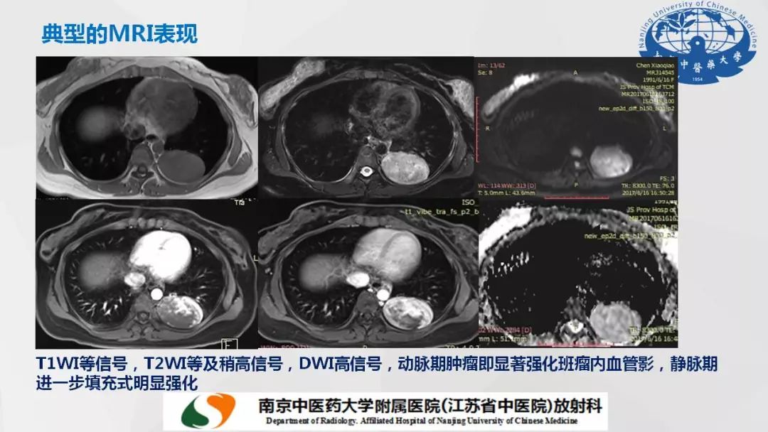 【PPT】孤立性纤维瘤的影像学表现