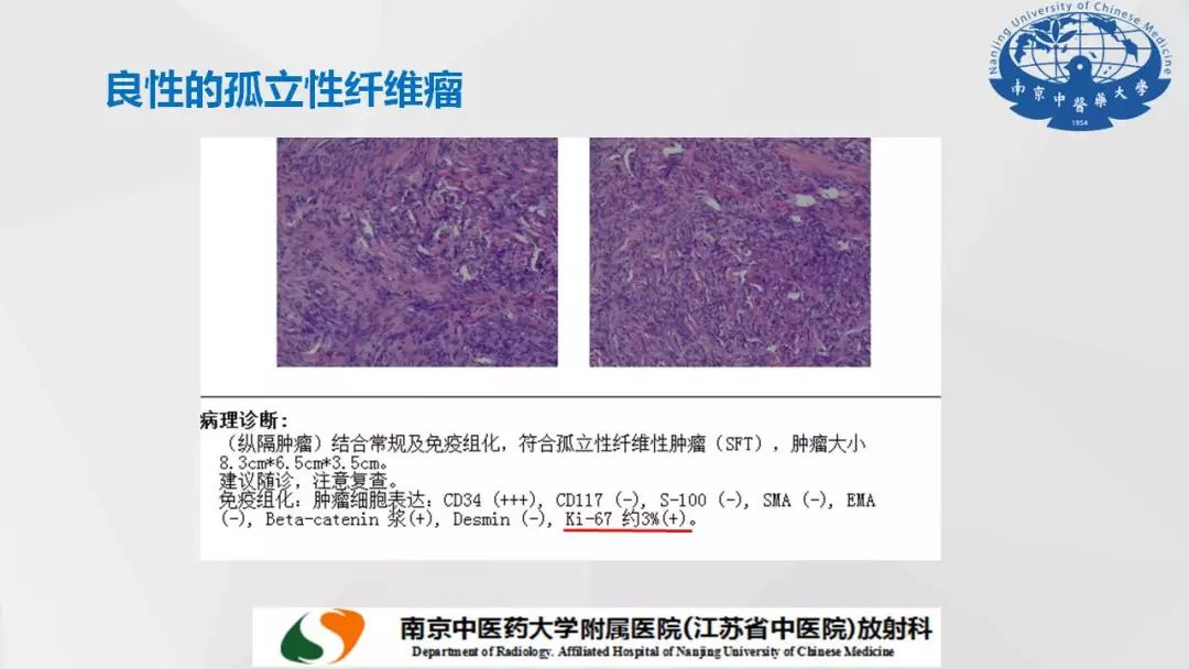 【PPT】孤立性纤维瘤的影像学表现