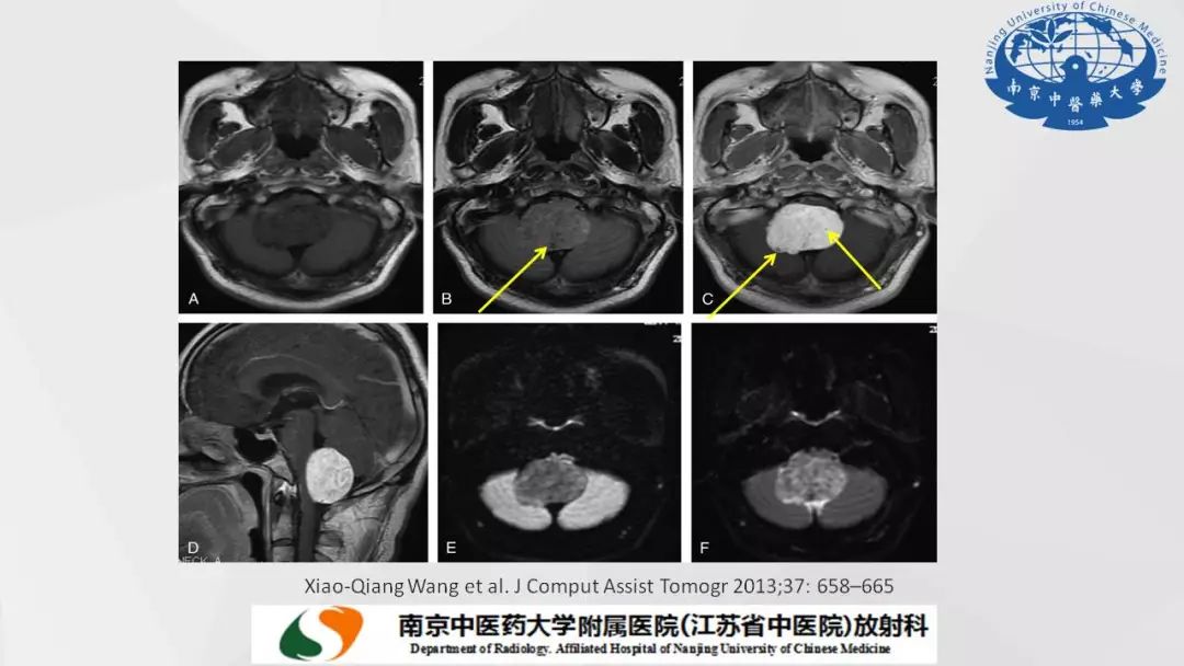 【PPT】孤立性纤维瘤的影像学表现