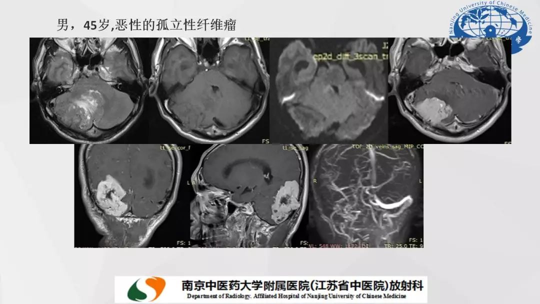 【PPT】孤立性纤维瘤的影像学表现