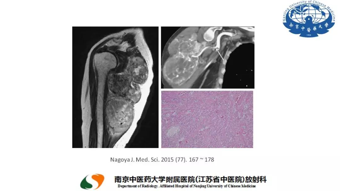 【PPT】孤立性纤维瘤的影像学表现