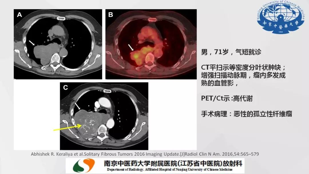 【PPT】孤立性纤维瘤的影像学表现