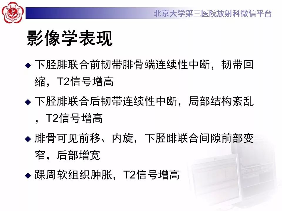 【病例】下胫腓联合韧带损伤1例影像表现