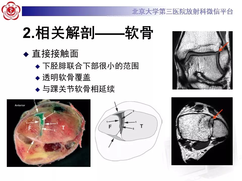 【病例】下胫腓联合韧带损伤1例影像表现