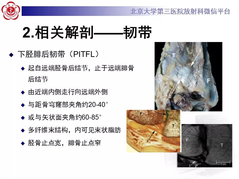 【病例】下胫腓联合韧带损伤1例影像表现