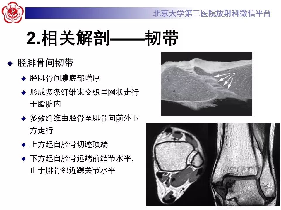 【病例】下胫腓联合韧带损伤1例影像表现
