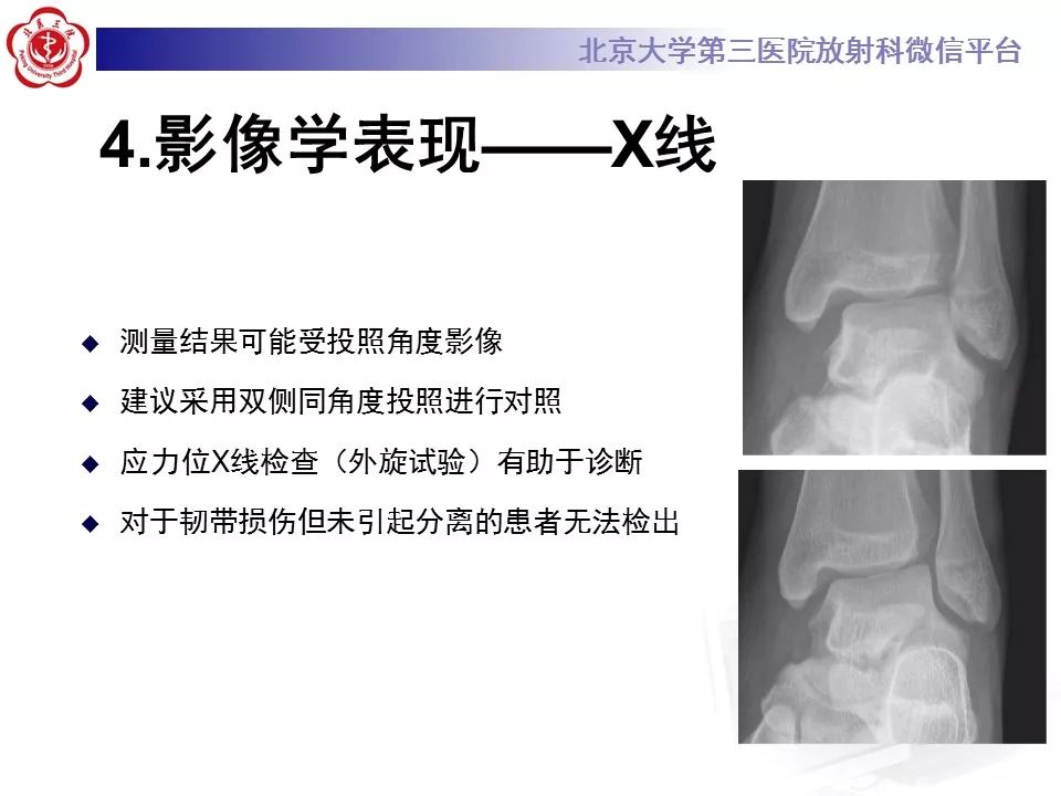 【病例】下胫腓联合韧带损伤1例影像表现