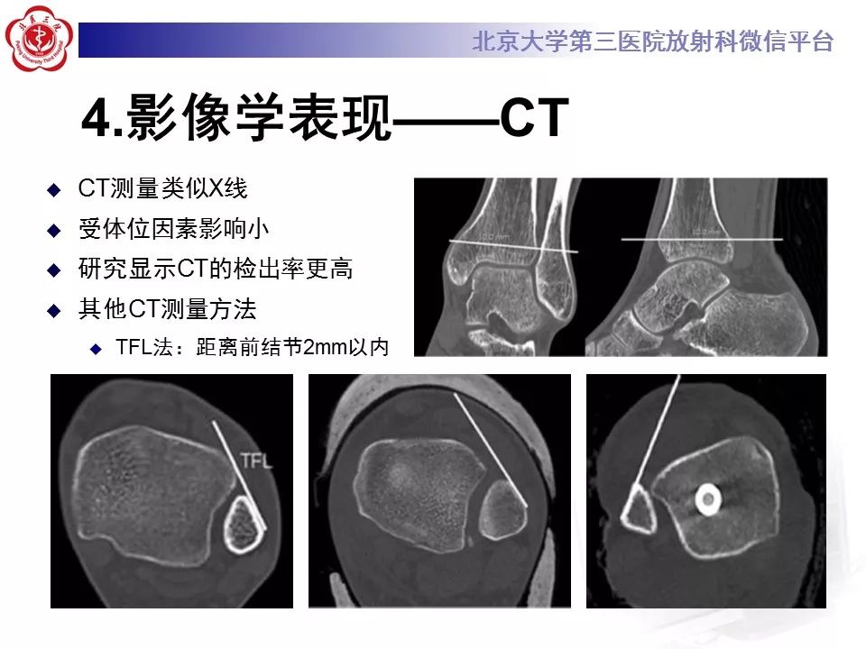 【病例】下胫腓联合韧带损伤1例影像表现