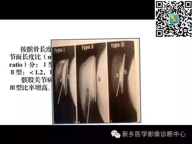 【PPT】髌骨软化症的影像诊断