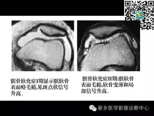 【PPT】髌骨软化症的影像诊断