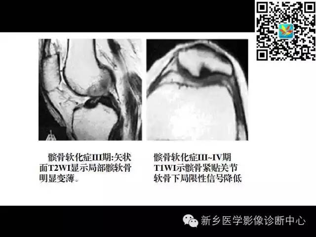 【PPT】髌骨软化症的影像诊断