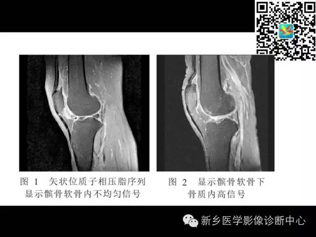 【PPT】髌骨软化症的影像诊断