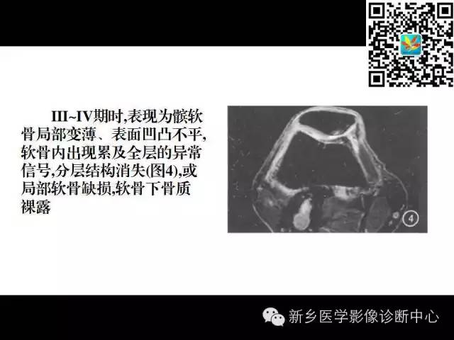 【PPT】髌骨软化症的影像诊断