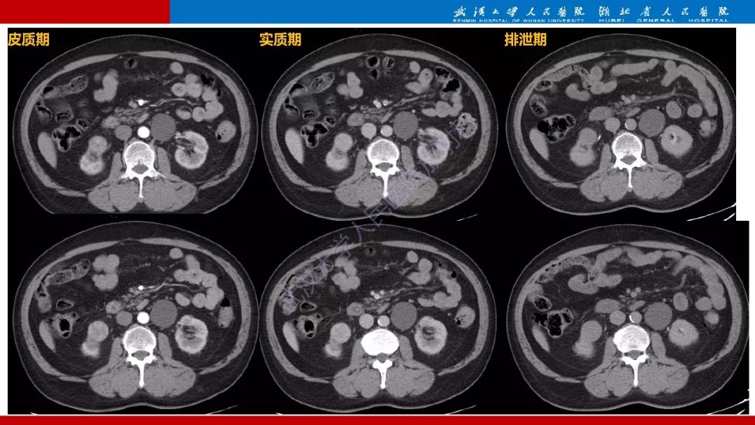 【PPT】肾脏嗜酸细胞腺瘤影像诊断
