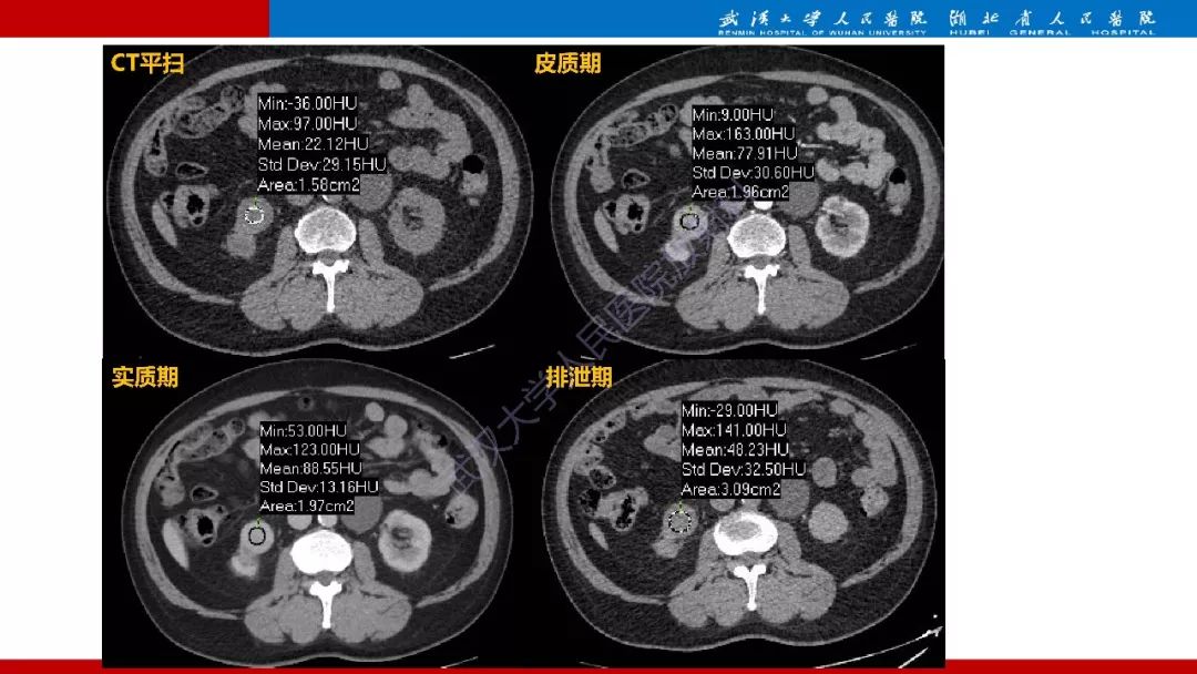 【PPT】肾脏嗜酸细胞腺瘤影像诊断