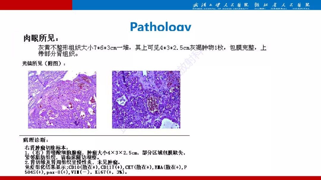 【PPT】肾脏嗜酸细胞腺瘤影像诊断