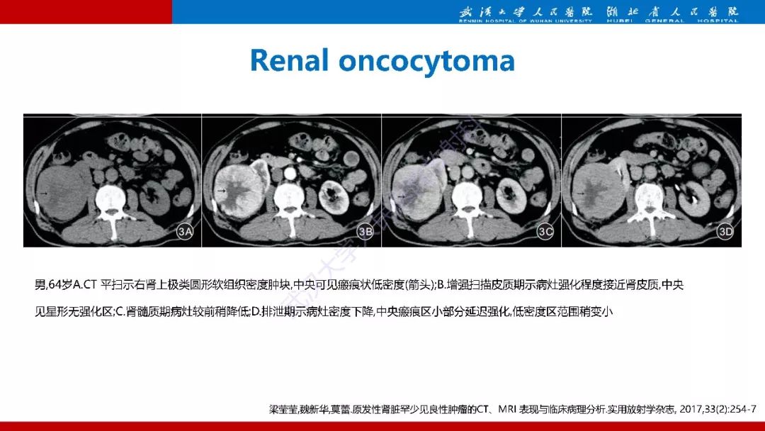 【PPT】肾脏嗜酸细胞腺瘤影像诊断