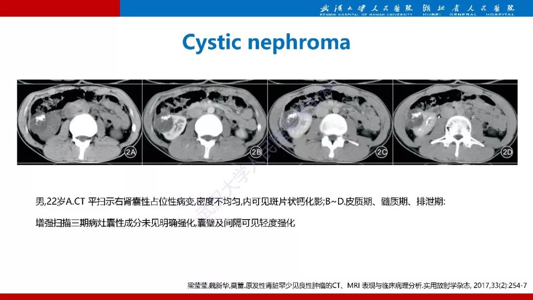 【PPT】肾脏嗜酸细胞腺瘤影像诊断