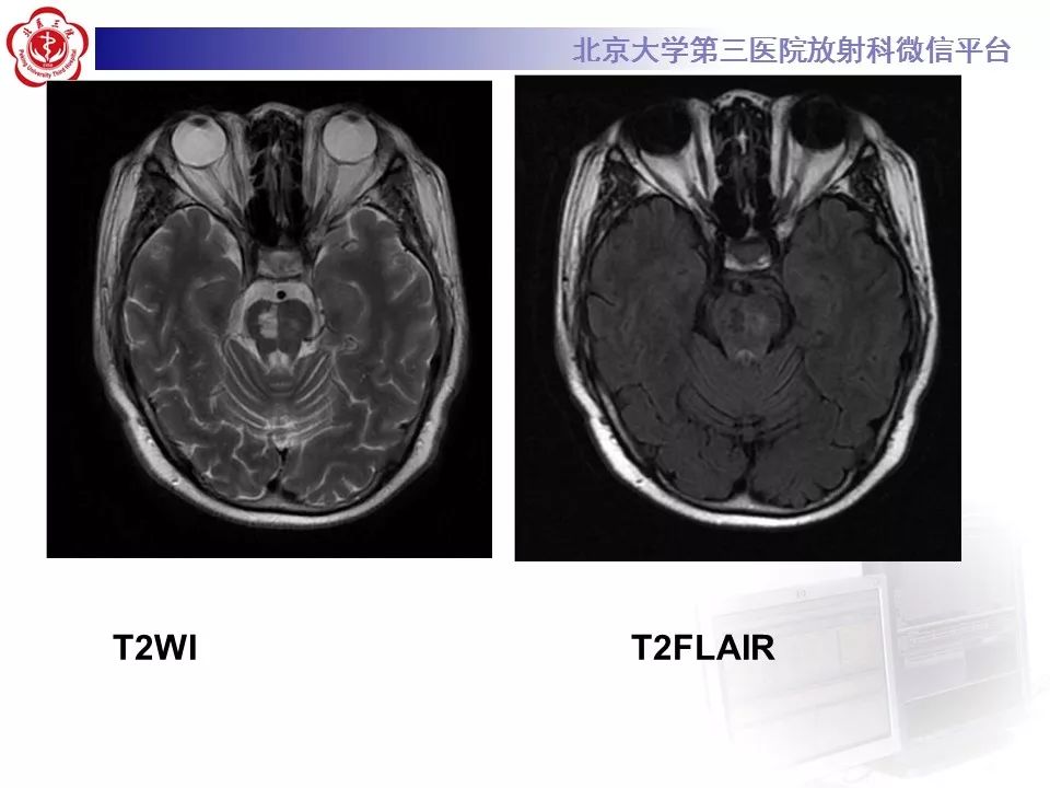 【病例】脑桥小脑束华勒变性1例MR