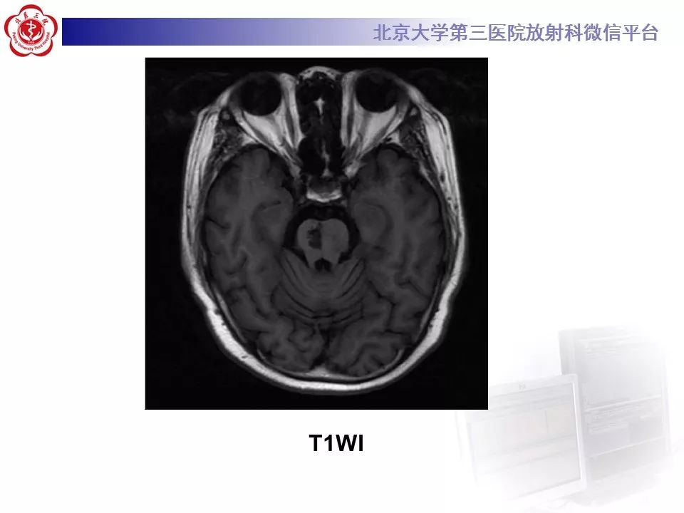 【病例】脑桥小脑束华勒变性1例MR