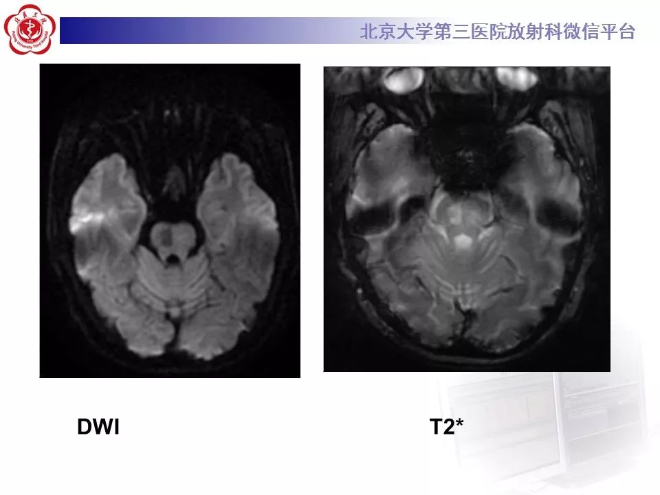【病例】脑桥小脑束华勒变性1例MR