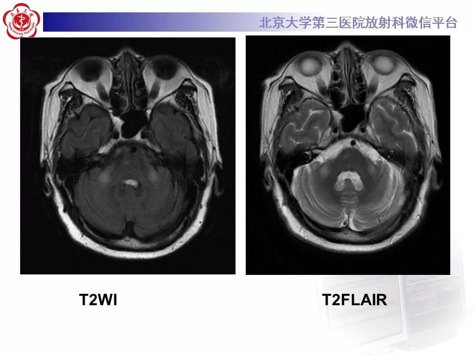 【病例】脑桥小脑束华勒变性1例MR
