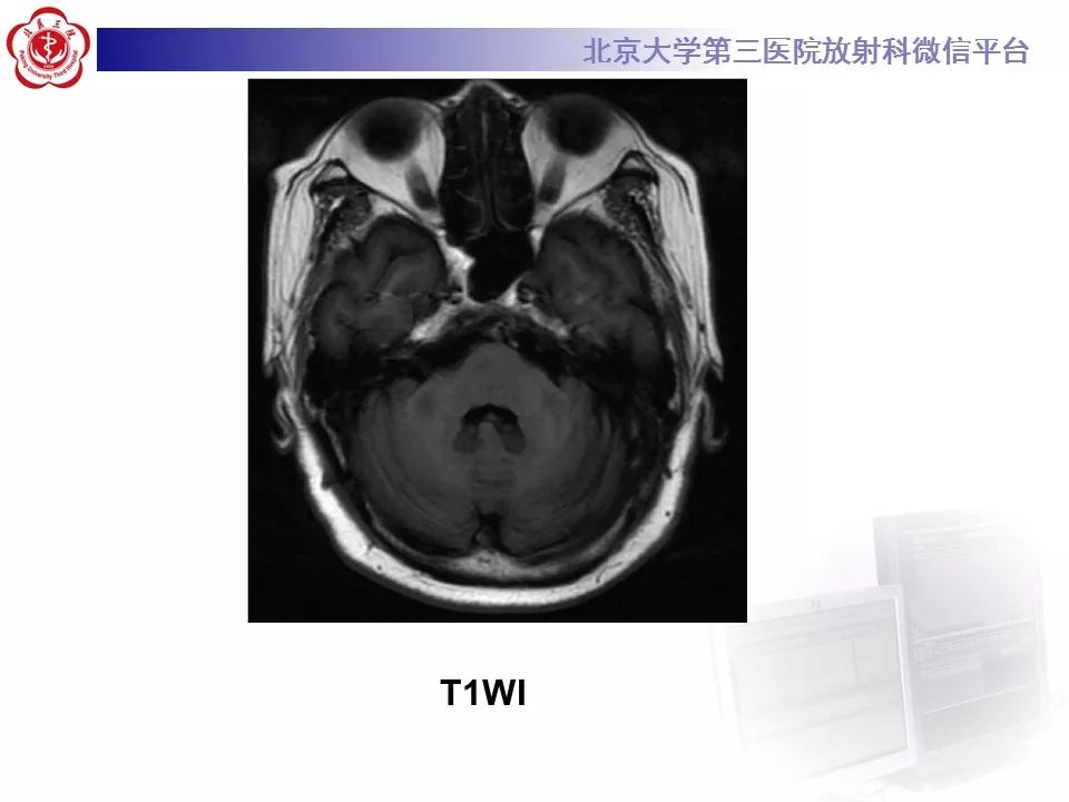 【病例】脑桥小脑束华勒变性1例MR