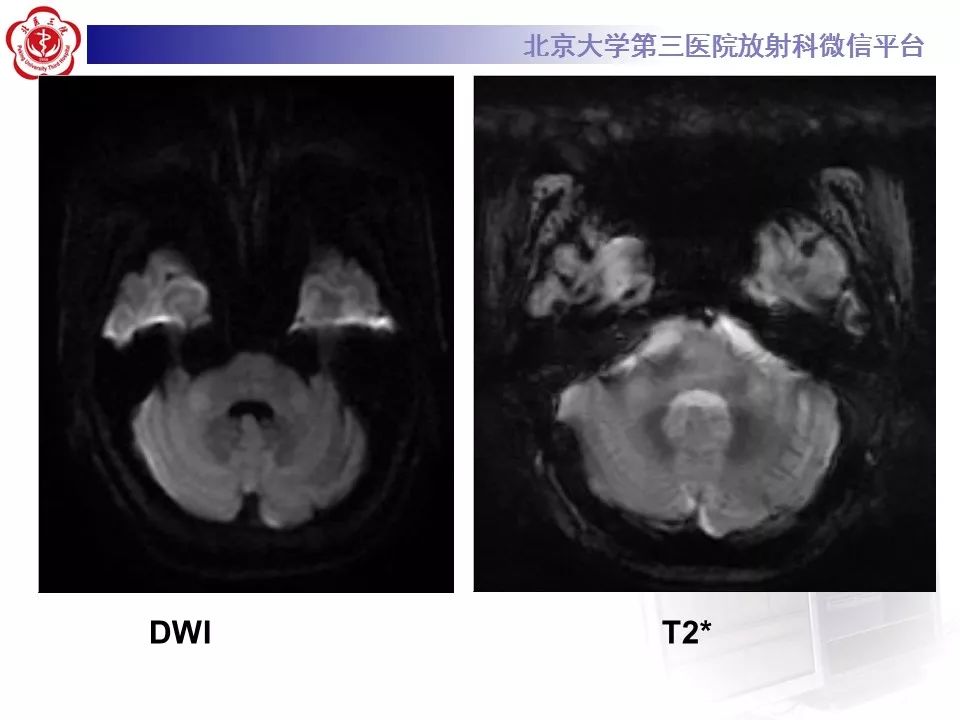 【病例】脑桥小脑束华勒变性1例MR