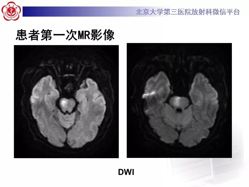 【病例】脑桥小脑束华勒变性1例MR