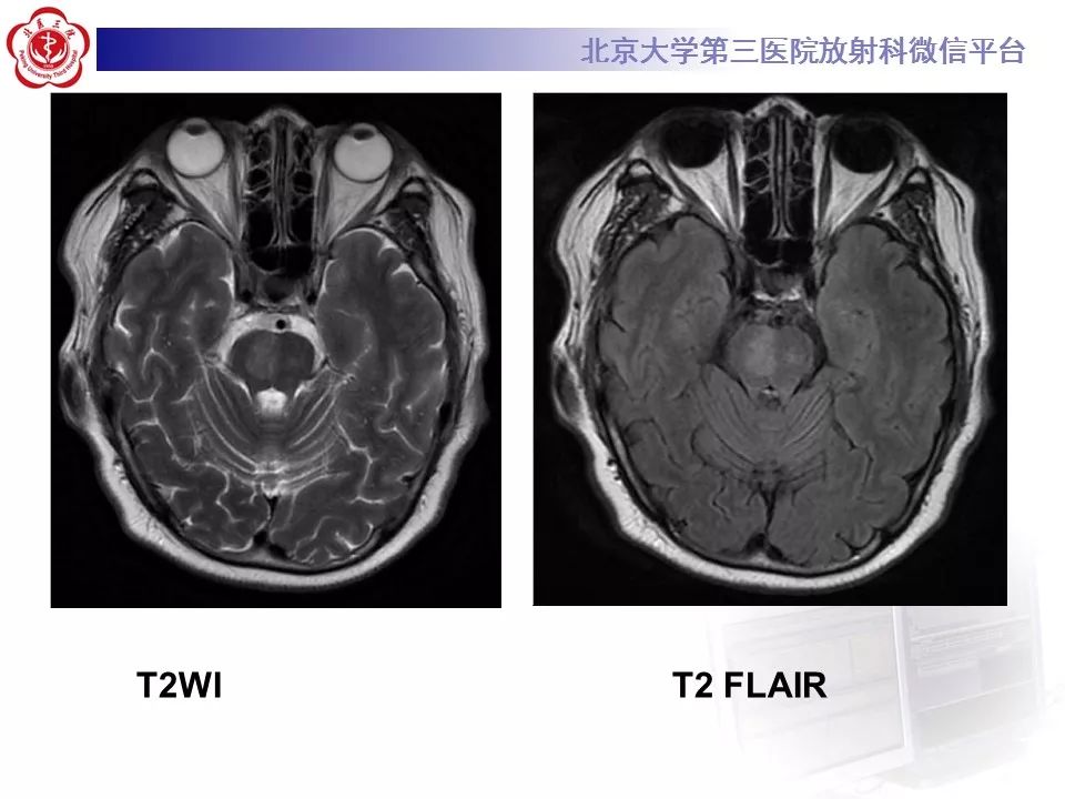 【病例】脑桥小脑束华勒变性1例MR