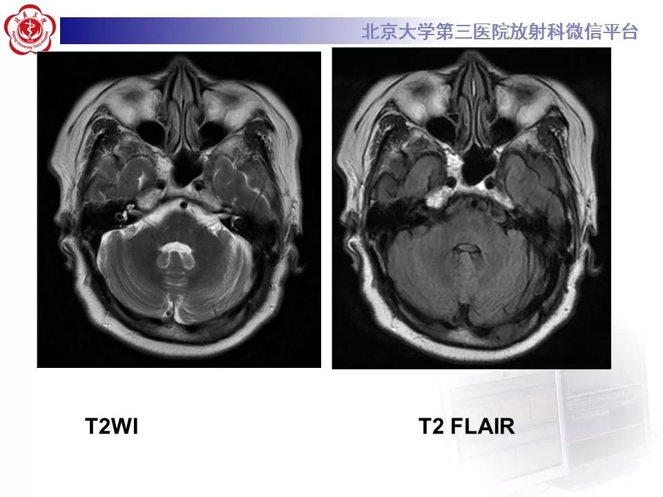 【病例】脑桥小脑束华勒变性1例MR