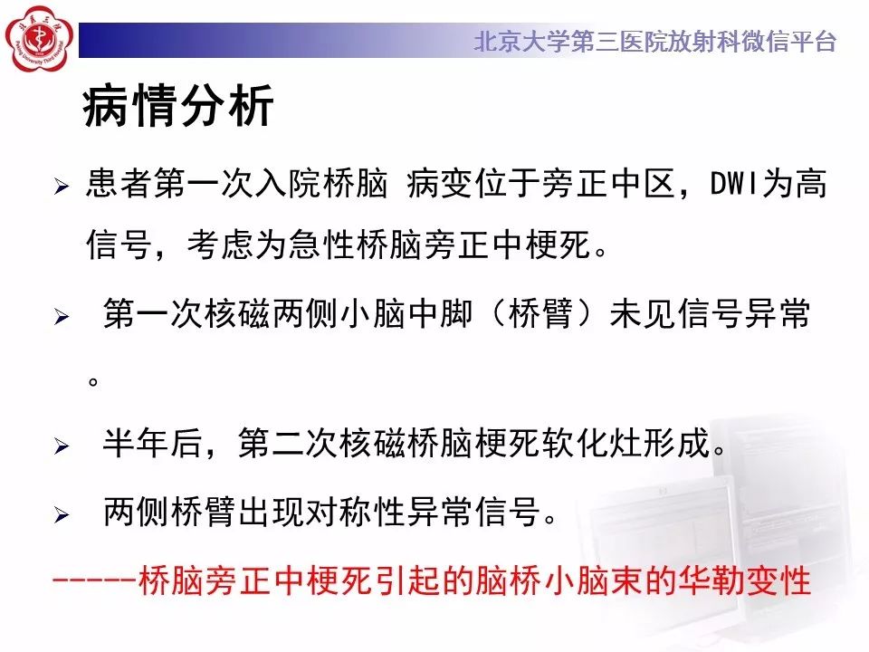 【病例】脑桥小脑束华勒变性1例MR