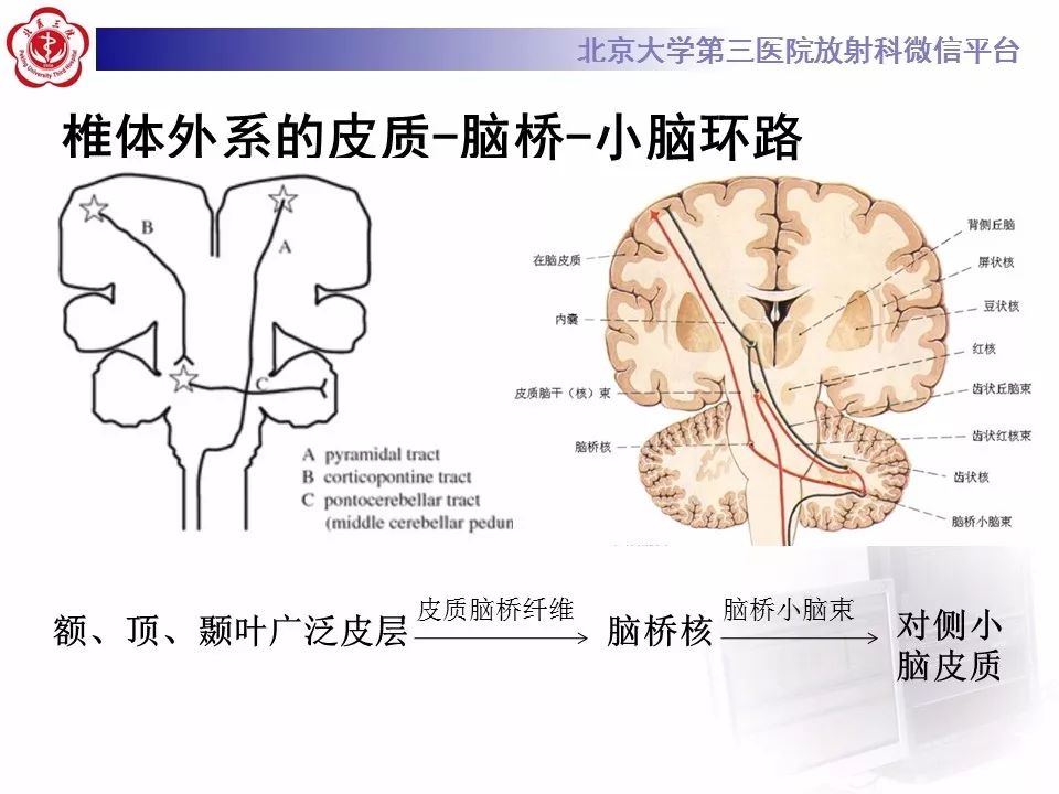 【病例】脑桥小脑束华勒变性1例MR