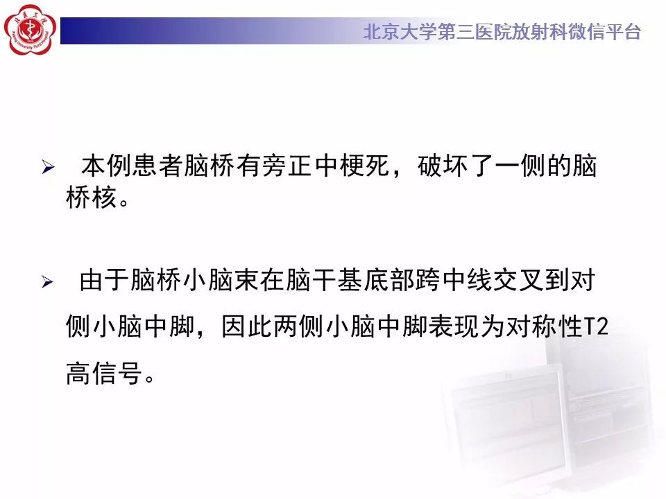 【病例】脑桥小脑束华勒变性1例MR