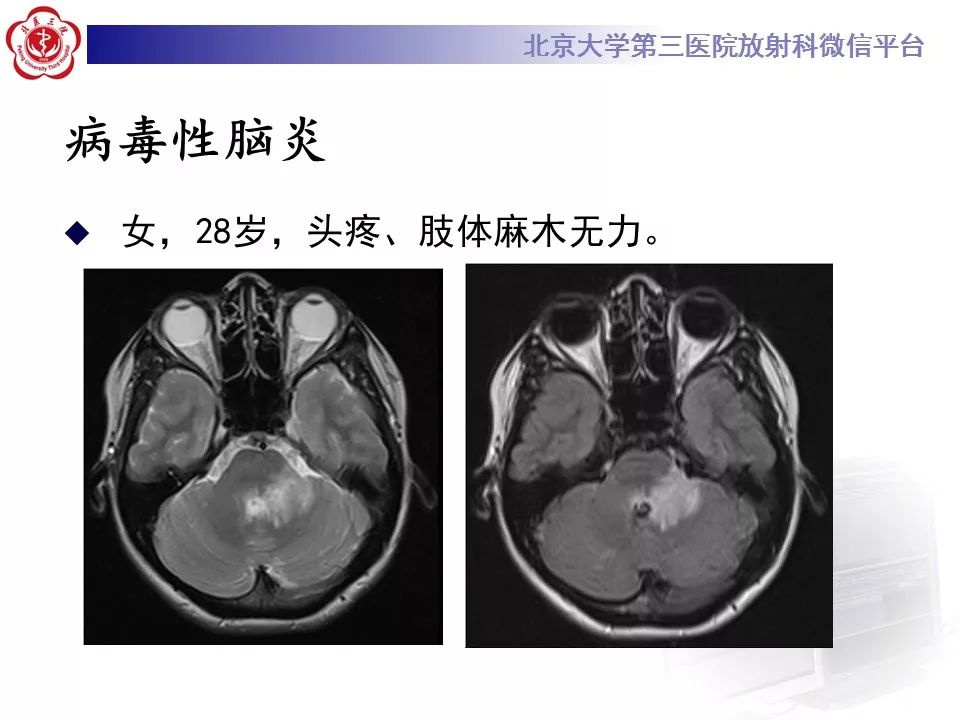 【病例】脑桥小脑束华勒变性1例MR