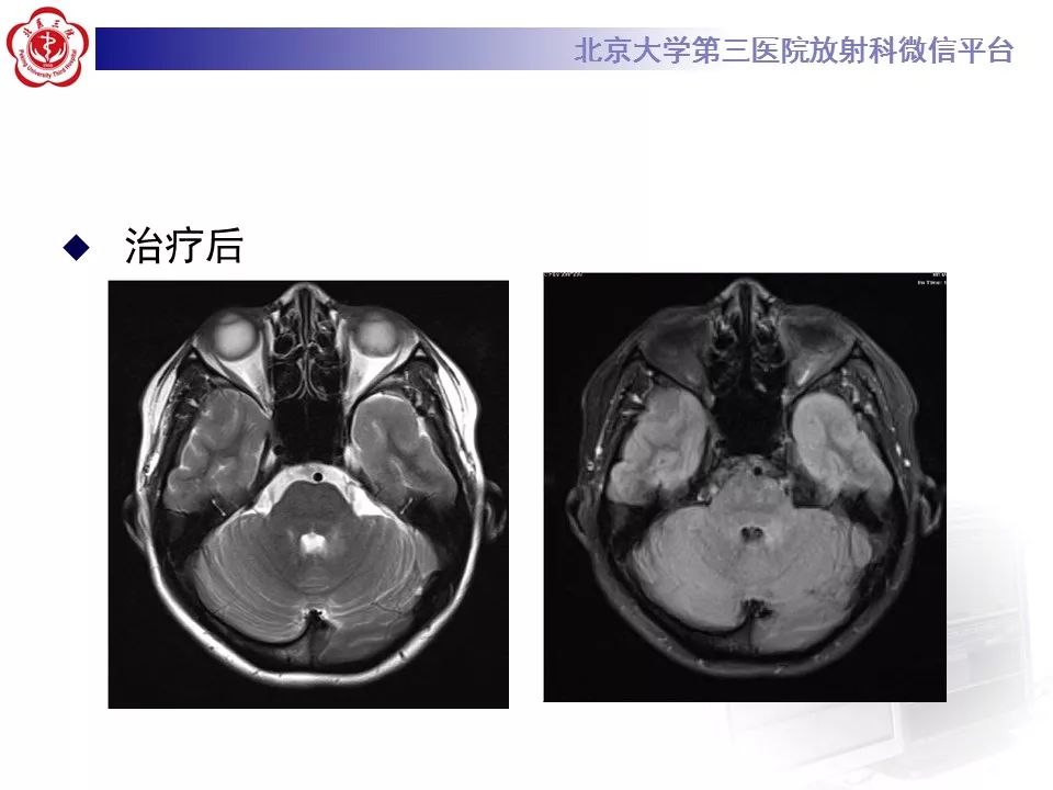 【病例】脑桥小脑束华勒变性1例MR