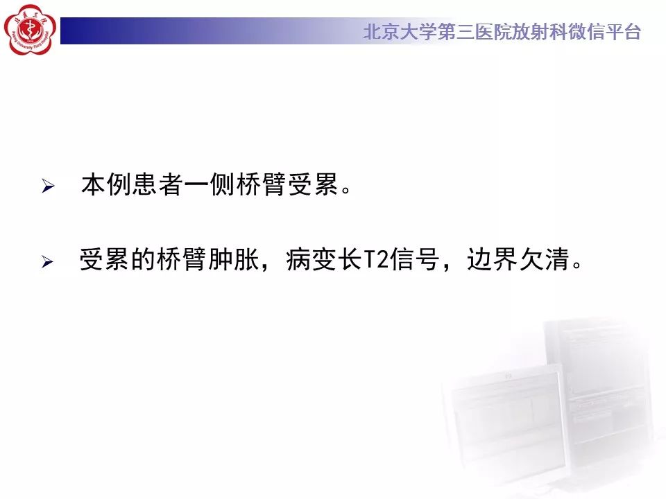 【病例】脑桥小脑束华勒变性1例MR
