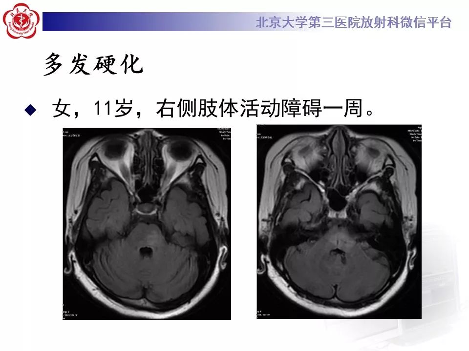 【病例】脑桥小脑束华勒变性1例MR