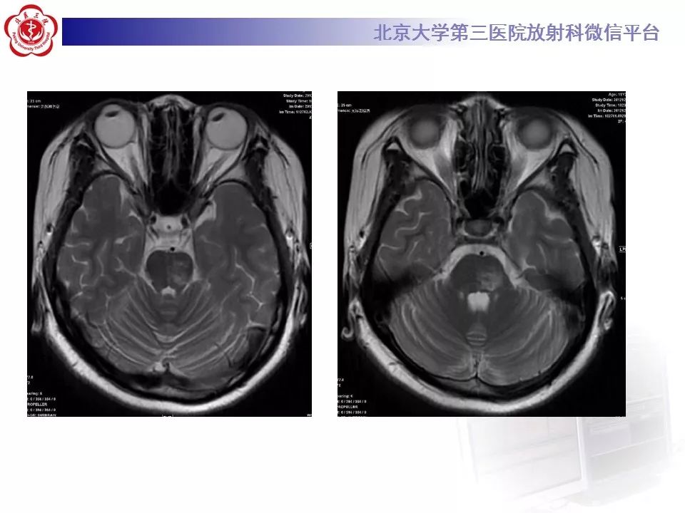 【病例】脑桥小脑束华勒变性1例MR