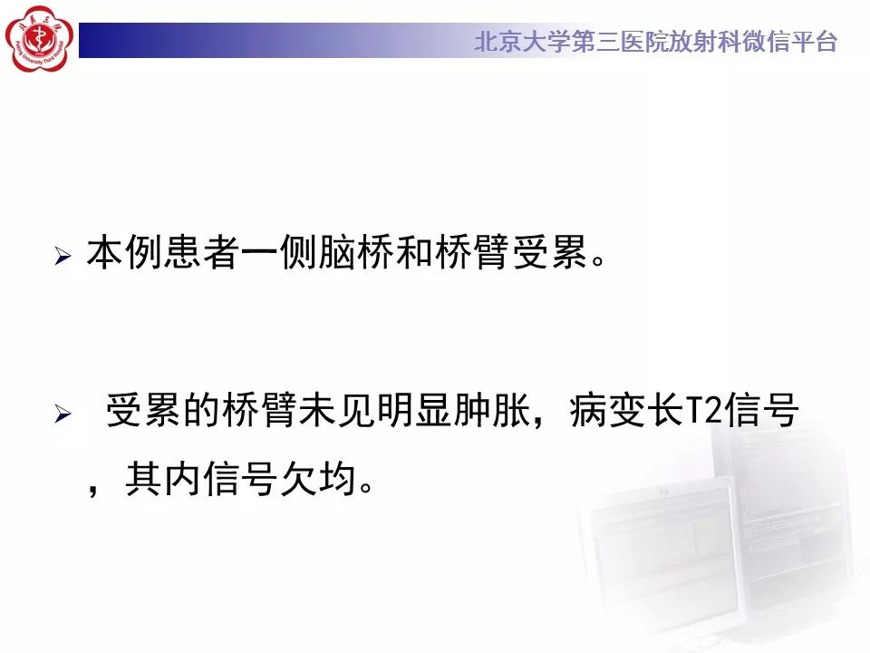 【病例】脑桥小脑束华勒变性1例MR