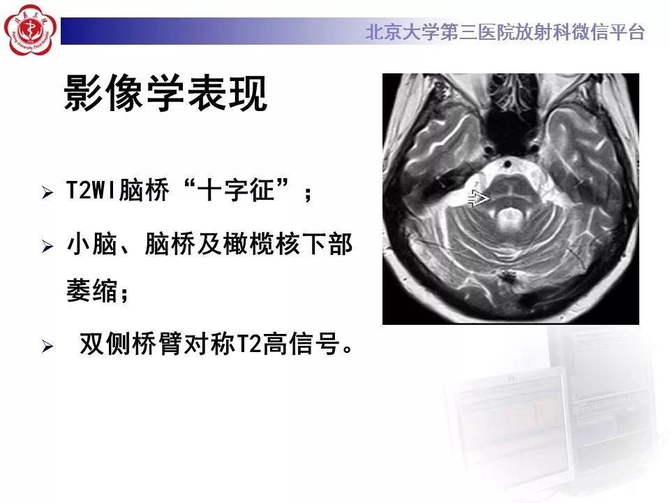 【病例】脑桥小脑束华勒变性1例MR